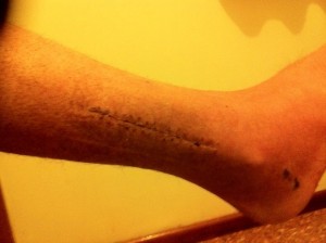 ... and the scar on the outer side of my leg.